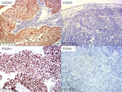 Absence of GATA3/FOXA1 co-expression predicts poor prognosis in upper tract urothelial carcinoma